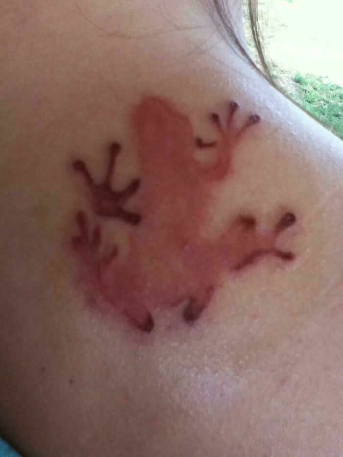 Blursed image of a red irritated skin patch resembling a lizard or gecko shape on a person's shoulder.
